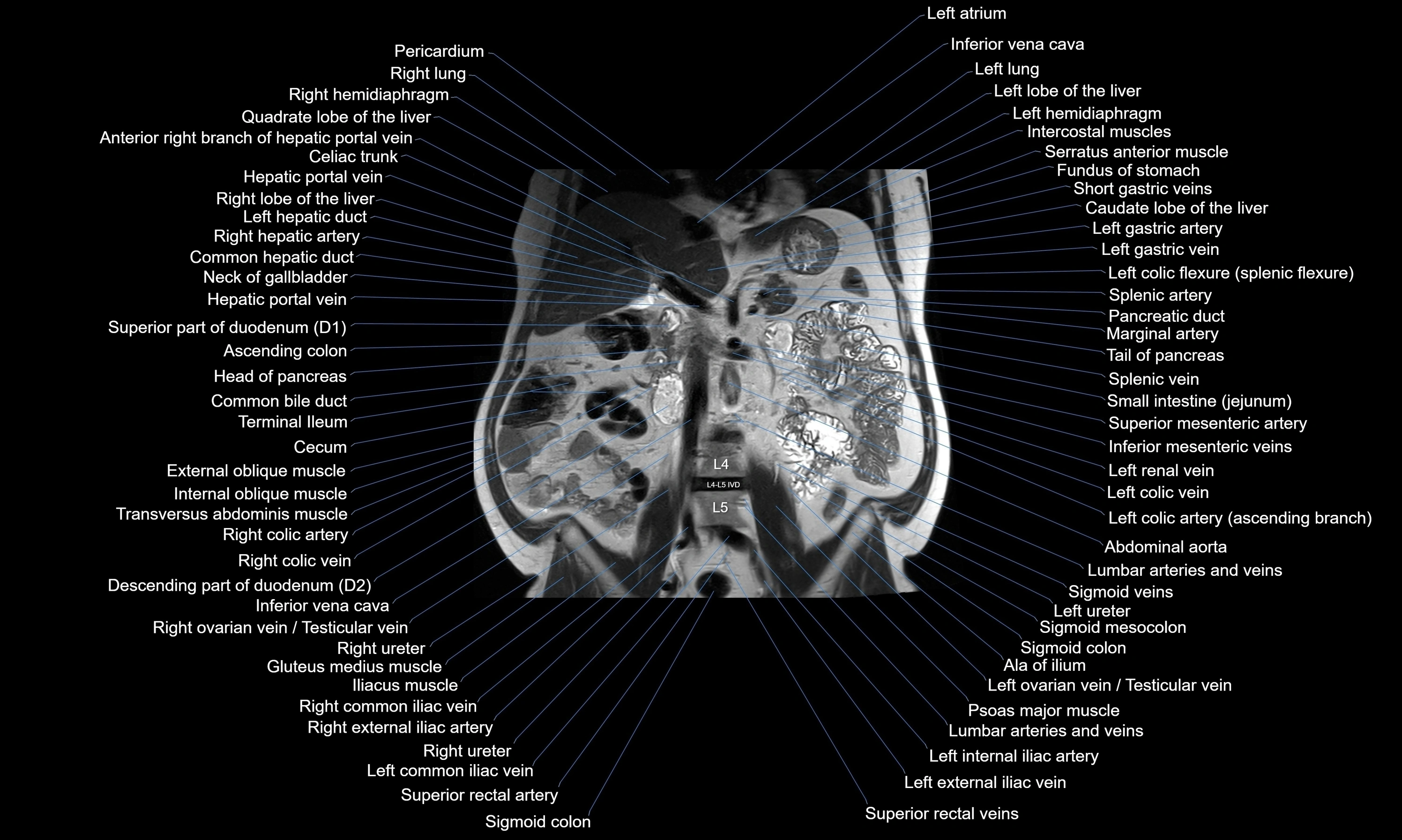 MRI Abdomen axial cross sectional anatomy radiology  image-img-00001-00030.webp
